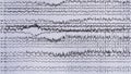 Imaging of ictal EEG recording in epilepsy patient