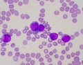 Immature white blood cells in blood smear