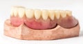 Immediate denture Upper