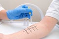 Immunologist Doing Skin Prick Allergy Test Royalty Free Stock Photo