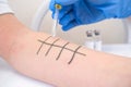 Immunologist Doing Skin Prick Allergy Test