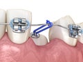 Impacted Cuspid and elastic for correction. Medically accurate dental 3D illustration