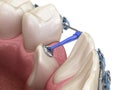 Impacted Cuspid and elastic for correction. Medically accurate dental 3D illustration Royalty Free Stock Photo