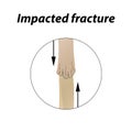 Impacted fracture Bone. Infographics. Vector illustration on a lined background. Royalty Free Stock Photo