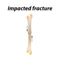 Impacted fracture Bone. Infographics. Vector illustration on a lined background. Royalty Free Stock Photo