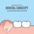 Impacted tooth inside under inflammation gum illustration vector Royalty Free Stock Photo