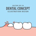 Impacted tooth inside under inflammation gum illustration vector Royalty Free Stock Photo