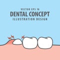 Impacted tooth inside under inflammation gum illustration vector