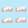 Impacted tooth or wisdom teeth dental and oral diseases