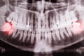 Impacted wisdom teeth on an X-ray picture with an inflamed cyst neoplasm. Removal of wisdom teeth in dentistry