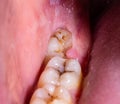 Impacted wisdom tooth due to which a gum hood was formed. Inflammation of the gums due to an unerupted molar, macro