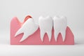 impacted wisdom tooth isolated background Royalty Free Stock Photo