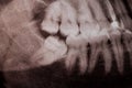 Impacted wisdom tooth on the lower jaw x-ray image, close-up Royalty Free Stock Photo