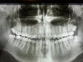 Impacted wizdom teeth panoramic xray Royalty Free Stock Photo