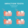 Impaction tooth. Dentistry stomatology vector Royalty Free Stock Photo