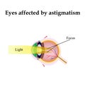 Impaired vision with astigmatism. As astigmatism affect vision Royalty Free Stock Photo