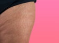 Imper fact skin problem in woman.Closeup stretch marks on woman`s leg isolated clipping mask on pink background.