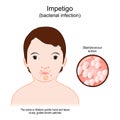 Impetigo. Face baby with a skin infection Royalty Free Stock Photo