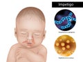 Impetigo is an infection caused by strains of staphylococcus or streptococcus bacteria. Impetigo skin infection affect