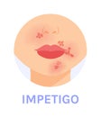 Impetigo. Skin Infection. Red Spots near the Mouth and Nose. Part of a Woman Face. Female Lips Nose and Neck. Color Cartoon style Royalty Free Stock Photo