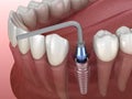 Implant abutment fixation procedure. Medically accurate 3D illustration of human teeth and dentures