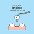 Implant illustration vector on blue background. Dental concept.