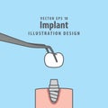 Implant illustration vector on blue background. Dental concept.