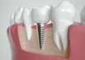Implant Integration in Jaw Anatomy Visualization - 3D Rendering Royalty Free Stock Photo