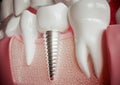 Implant next to a healthy molar - 3D rendering