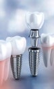 Implant tooth method: surgical fixture, molar replacement, gum grafting, structural post, oral engineering, bone Royalty Free Stock Photo