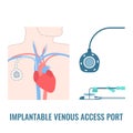 Implantable venous access port on male body Royalty Free Stock Photo