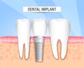 Implantation of human teeth. Dentistry. Dentistry. Realistic dental implant structure with all parts: crown, abutment, screw. Heal