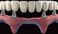 The implantation process in dentistry, generative AI