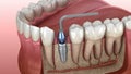 Implantation process in details: 3D animation of Drilling, implantat instalation, abutment and crown fixation