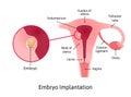 Implantation. stage of pregnancy when embryo adheres to the wall of the uterus. Parts of uterus are marked with lines Royalty Free Stock Photo