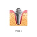 Implantation Third Stage Composition