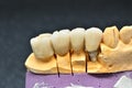 Porcelain teeth crown Royalty Free Stock Photo