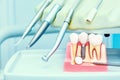 Implantology concept. Dental implants with mirror in dental clinic Royalty Free Stock Photo