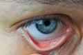Instill eyedrops or ointment on eye
