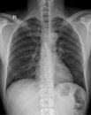 The Importance of Thoracic X-Rays for Chest Pain and Respiratory Issues
