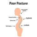 Improper posture symptoms. Text Neck Syndrome. Spinal curvature, kyphosis, lordosis, scoliosis, arthrosis. Improper