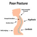 Improper posture symptoms. Text Neck Syndrome. Spinal curvature, kyphosis, lordosis, scoliosis, arthrosis. Improper