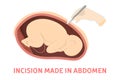 Incision making stage of birth via cesarean section