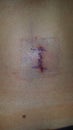 Incision L5 Surgery spine