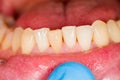 Incisors as Subject of Dental Photography