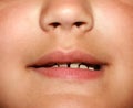 Incorrect bite in a child. Malocclusion in children. Crooked teeth.