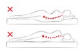 The incorrect spine alignment when sleeping.