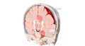 The increased pressure of subdural hematomas can lead to tissue shifts in the brain (brain herniations