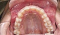 Dentistry case of upper maxillary arch