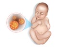 Infant presenting with the characteristic blisters of chickenpox. Chickenpox or varicella, is a highly contagious